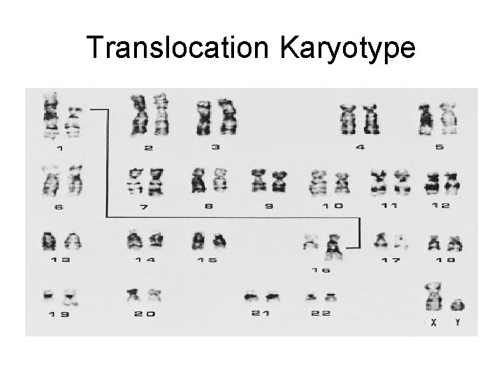 Translocation Karyotype 