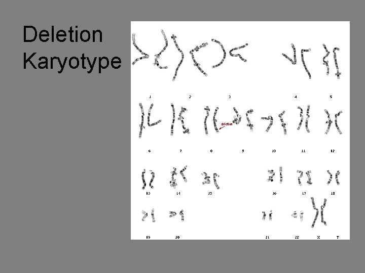 Deletion Karyotype 