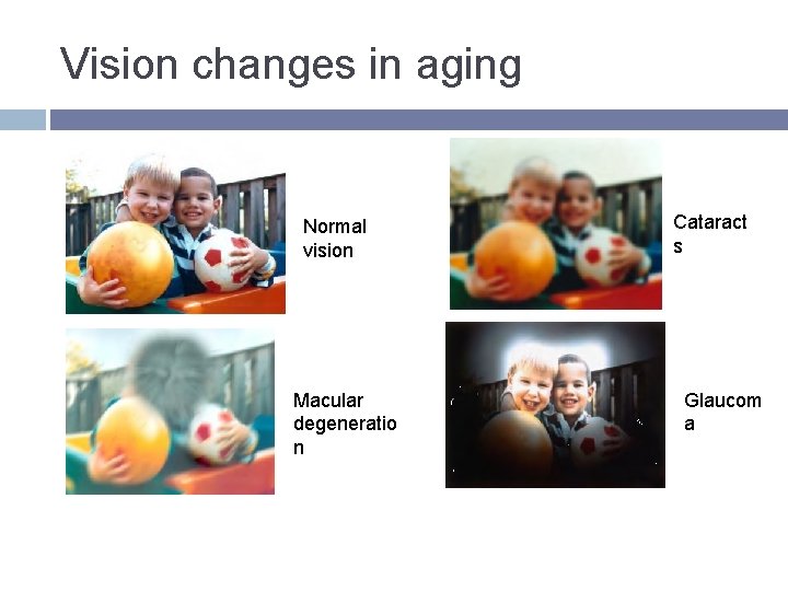 Vision changes in aging Normal vision Macular degeneratio n Cataract s Glaucom a Vision changes in aging Normal vision Macular degeneratio n Cataract s Glaucom a