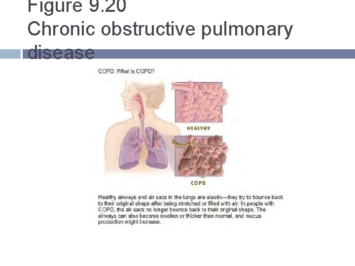 Figure 9. 20 Chronic obstructive pulmonary disease Figure 9. 20 Chronic obstructive pulmonary disease
