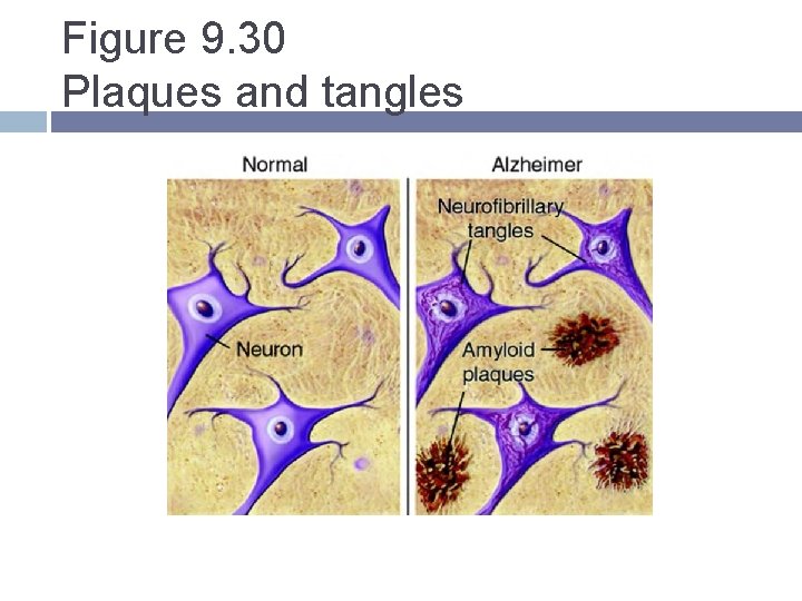 Figure 9. 30 Plaques and tangles Figure 9. 30 Plaques and tangles