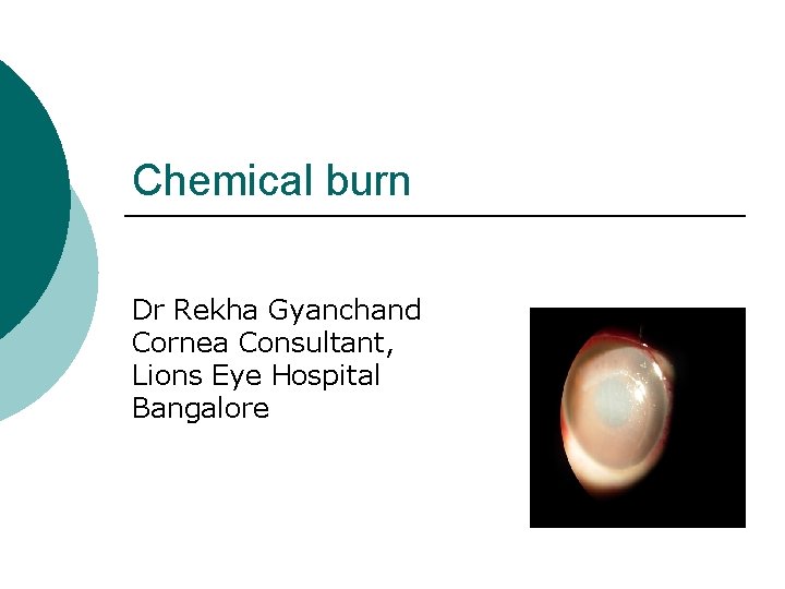 Chemical burn Dr Rekha Gyanchand Cornea Consultant, Lions Eye Hospital Bangalore 