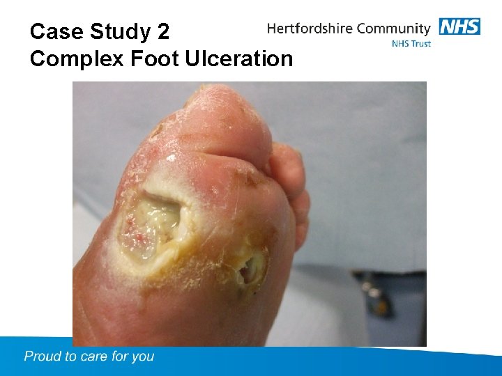 Case Study 2 Complex Foot Ulceration 