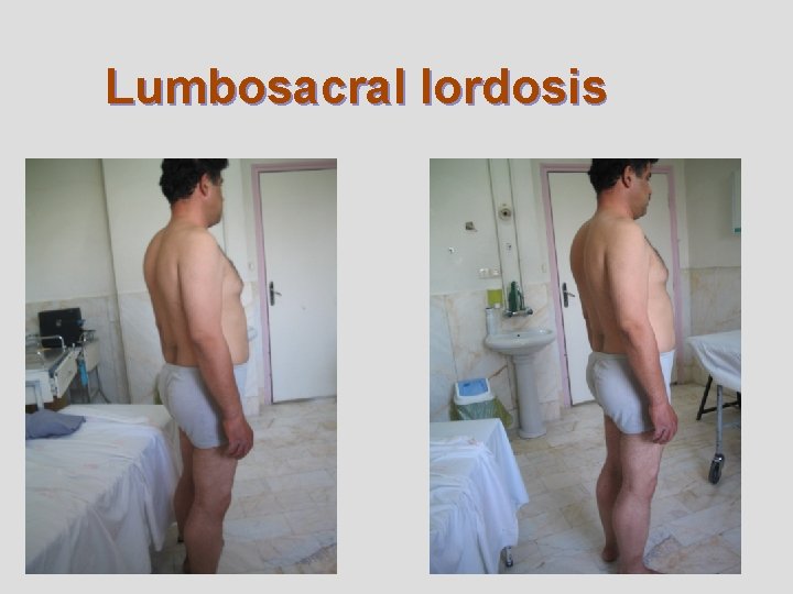 Lumbosacral lordosis 