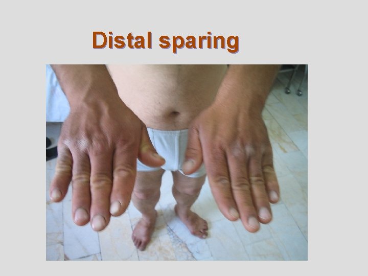 Distal sparing 