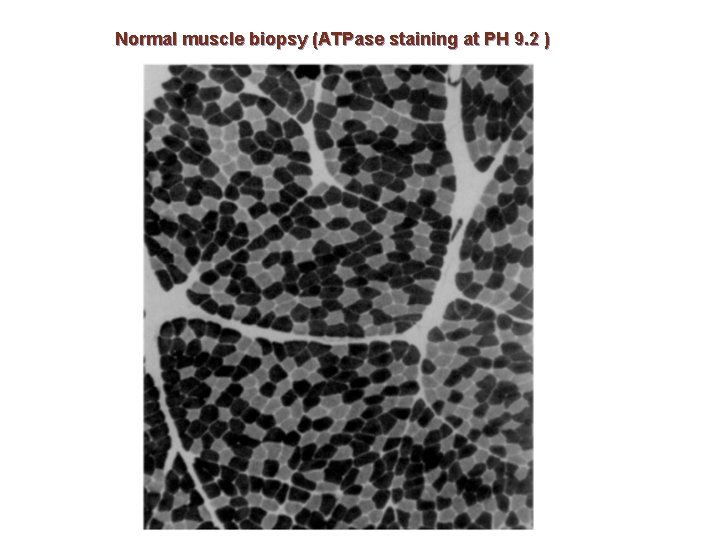 Normal muscle biopsy (ATPase staining at PH 9. 2 ) 