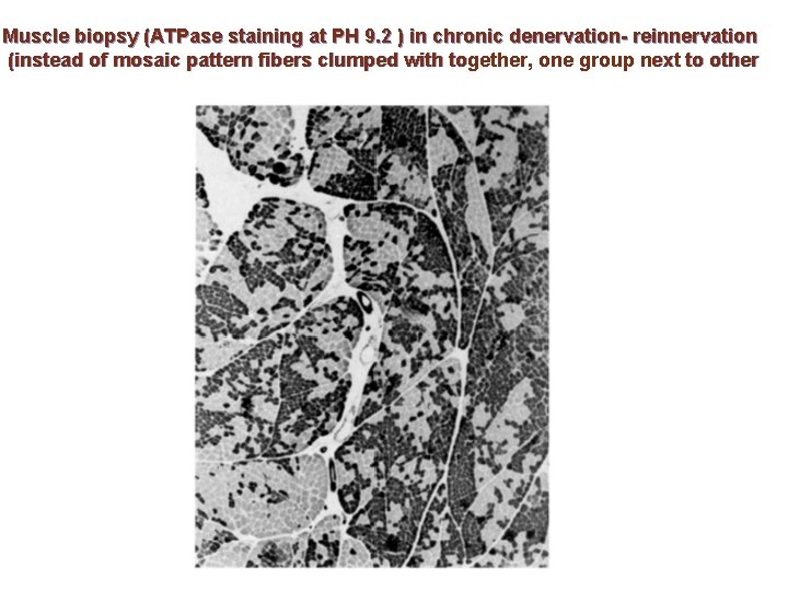 Muscle biopsy (ATPase staining at PH 9. 2 ) in chronic denervation- reinnervation (instead