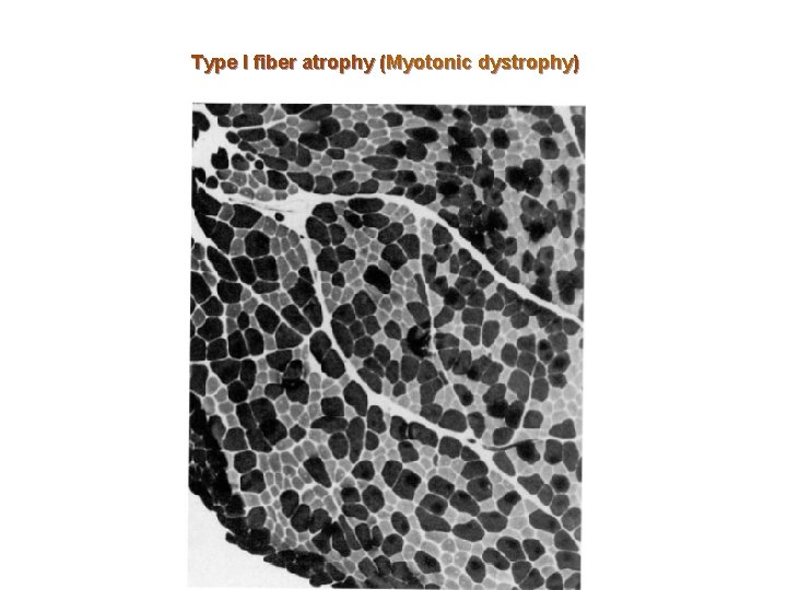 Type I fiber atrophy (Myotonic dystrophy) 