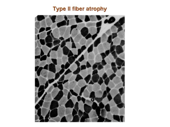 Type II fiber atrophy 