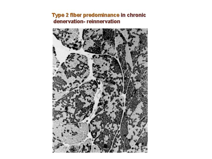 Type 2 fiber predominance in chronic denervation- reinnervation 