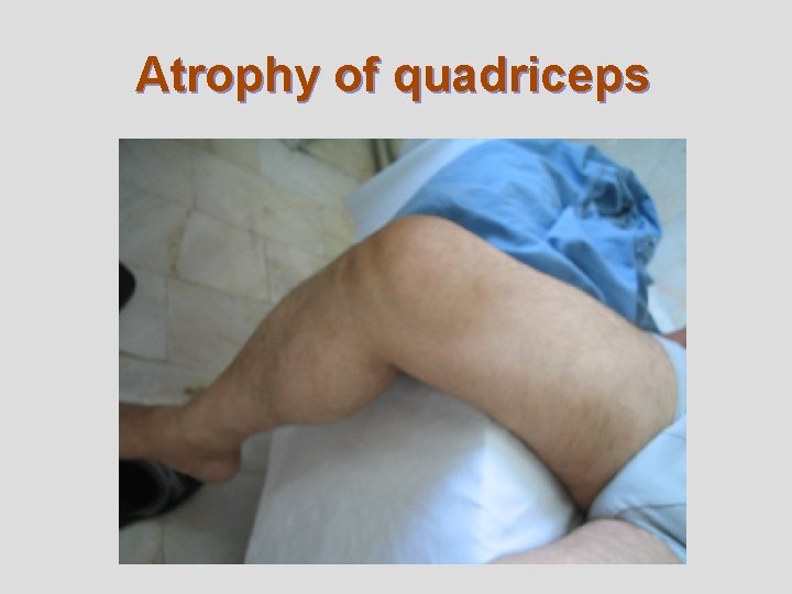 Atrophy of quadriceps 