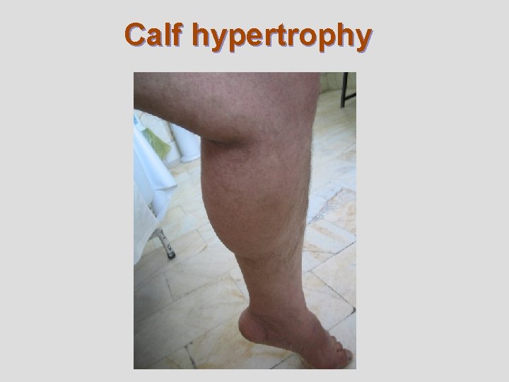 Calf hypertrophy 