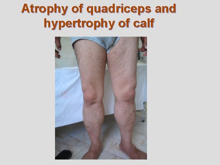Atrophy of quadriceps and hypertrophy of calf Atrophy of quadriceps and hypertrophy of calf