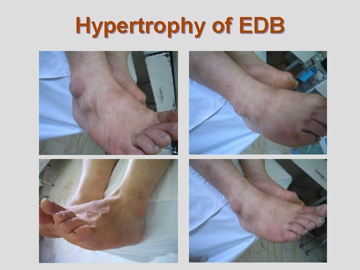 Hypertrophy of EDB 