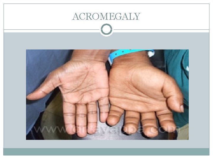 ACROMEGALY 