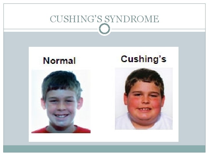 CUSHING’S SYNDROME 