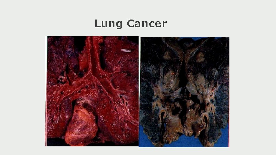 Lung Cancer 