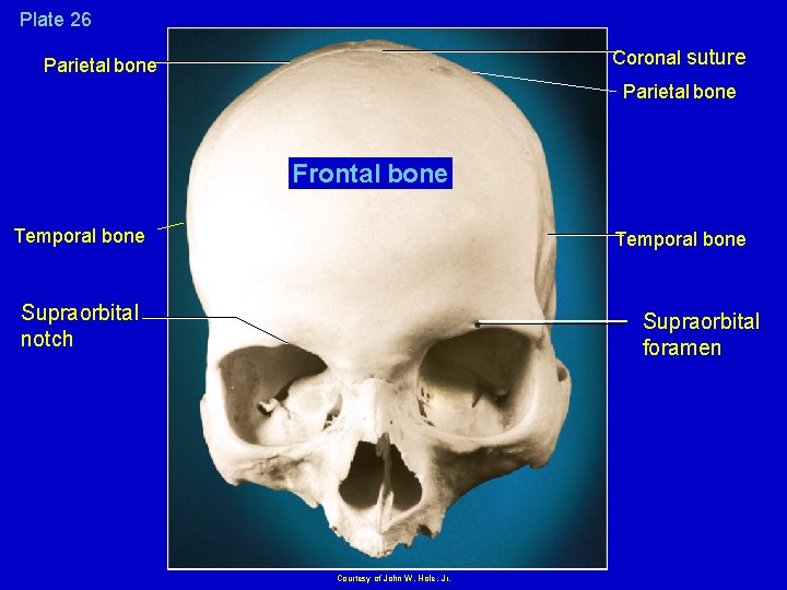 Plate 26 Coronal suture Parietal bone Plate 7. 26 Parietal bone Frontal bone Temporal