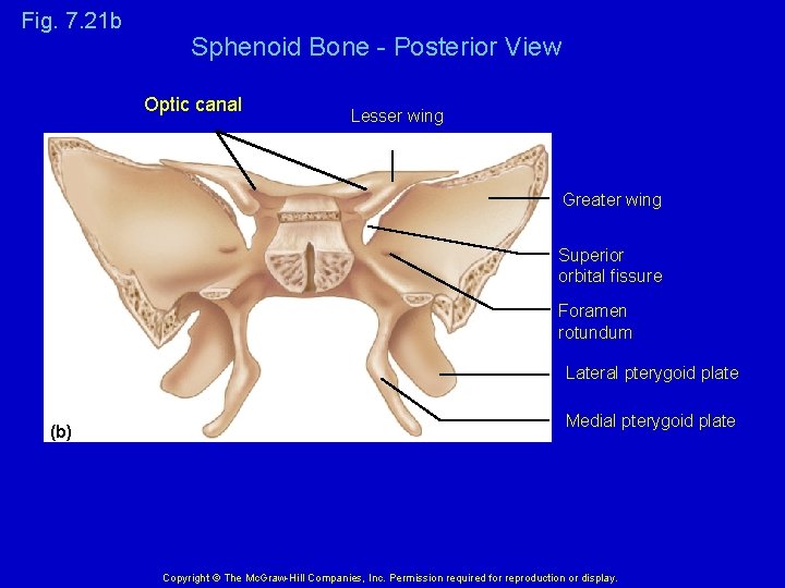 Fig. 7. 21 b Sphenoid Bone - Posterior View Optic canal Lesser wing Greater