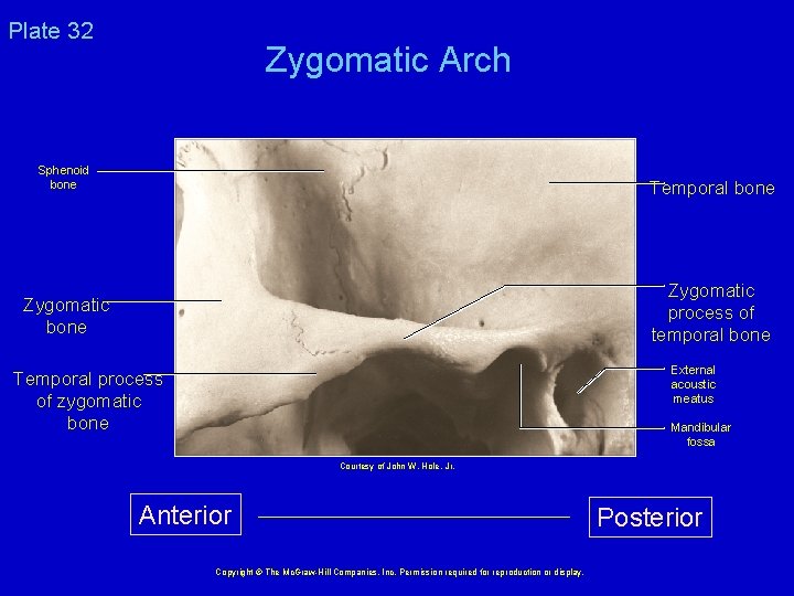 Plate 32 Zygomatic Arch Sphenoid bone Temporal bone Zygomatic process of temporal bone Zygomatic