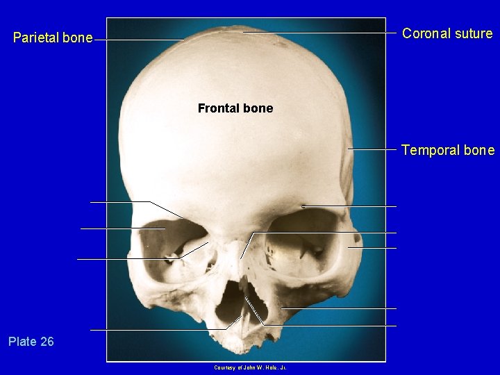 Coronal suture Parietal bone Plate 7. 26 Frontal bone Temporal bone Plate 26 Courtesy