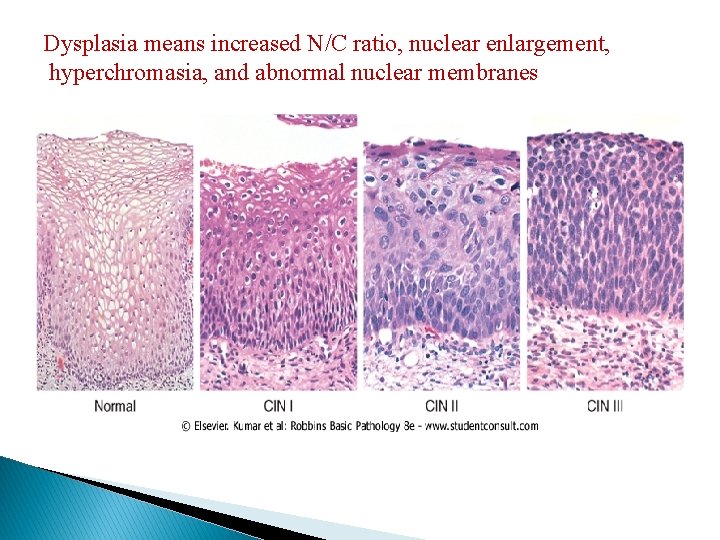 Dysplasia means increased N/C ratio, nuclear enlargement, hyperchromasia, and abnormal nuclear membranes Dysplasia means increased N/C ratio, nuclear enlargement, hyperchromasia, and abnormal nuclear membranes