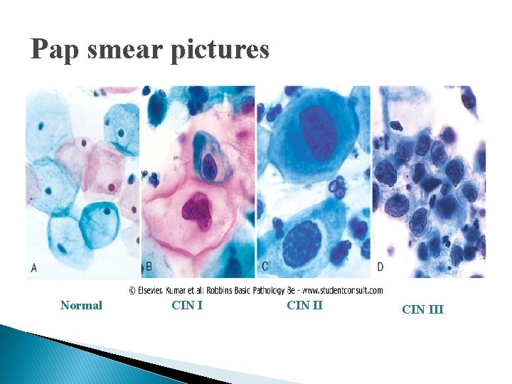 Pap smear pictures Normal CIN III Pap smear pictures Normal CIN III