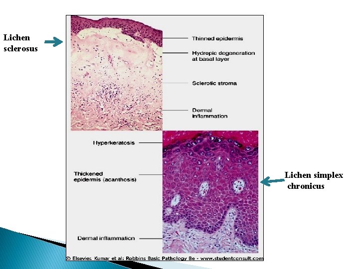 Lichen sclerosus Lichen simplex chronicus Lichen sclerosus Lichen simplex chronicus