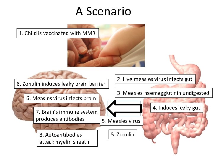 A Scenario 1. Child is vaccinated with MMR 6. Zonulin induces leaky brain barrier