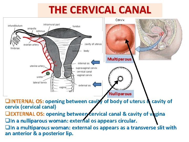 THE CERVICAL CANAL Multiparous Nulliparous q. INTERNAL OS: opening between cavity of body of THE CERVICAL CANAL Multiparous Nulliparous q. INTERNAL OS: opening between cavity of body of