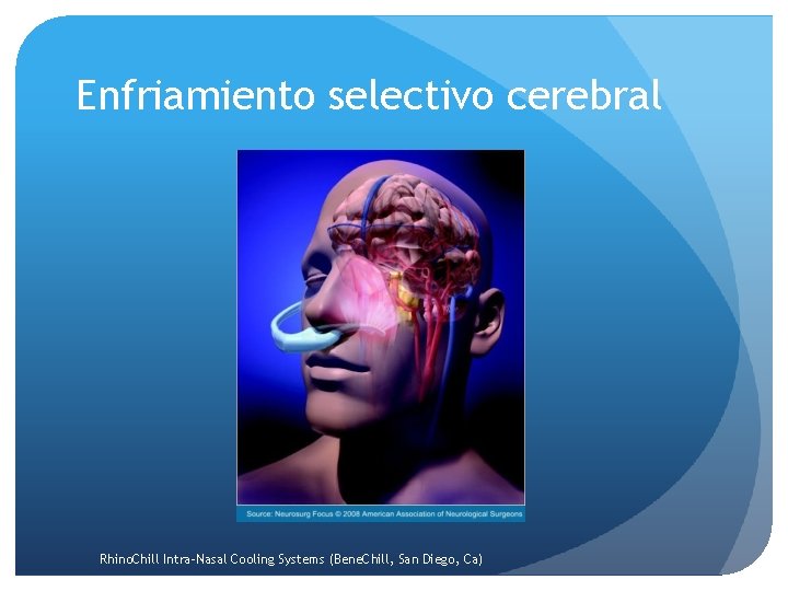 Enfriamiento selectivo cerebral Rhino. Chill Intra-Nasal Cooling Systems (Bene. Chill, San Diego, Ca) 