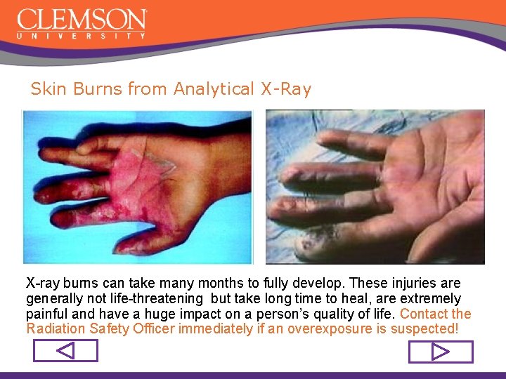 Skin Burns from Analytical X-Ray X-ray burns can take many months to fully develop.