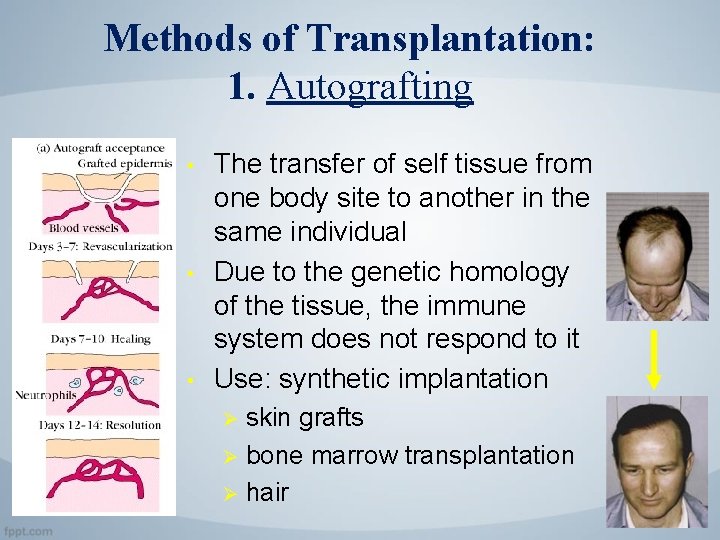 Methods of Transplantation: 1. Autografting • • • The transfer of self tissue from