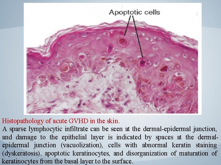 Histopathology of acute GVHD in the skin. A sparse lymphocytic infiltrate can be seen