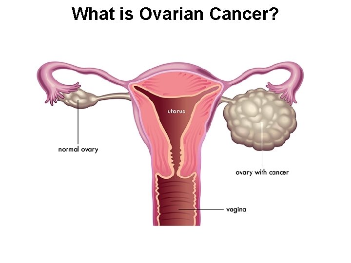 What is Ovarian Cancer? 