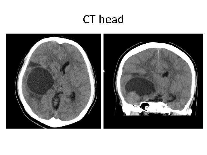 CT head 