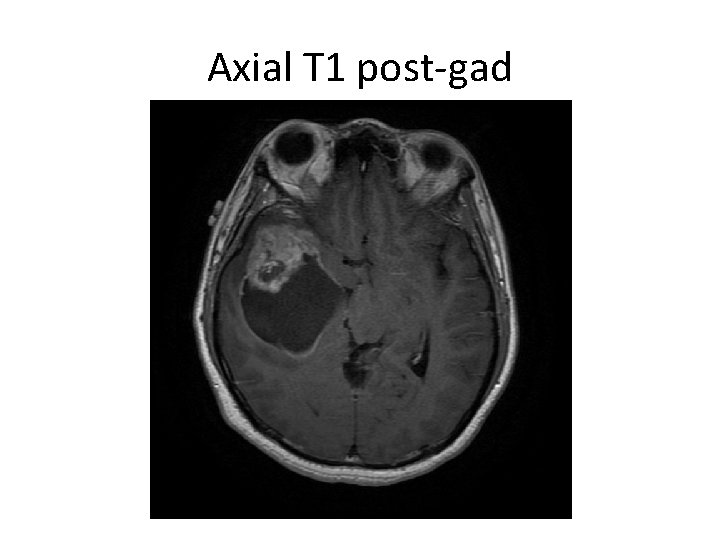 Axial T 1 post-gad 