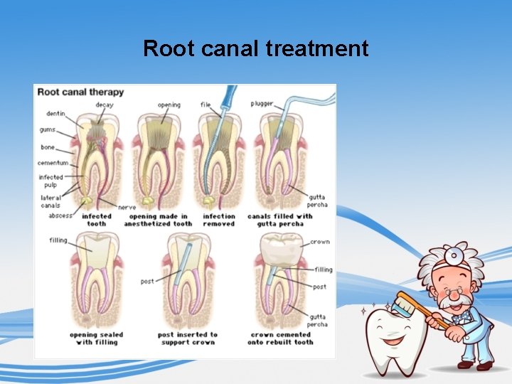 Root canal treatment 