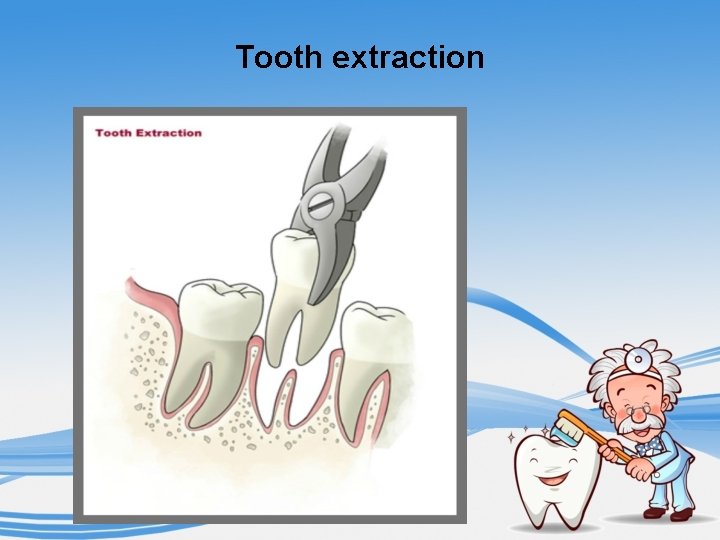 Tooth extraction 