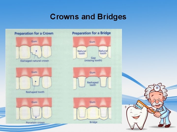 Crowns and Bridges 
