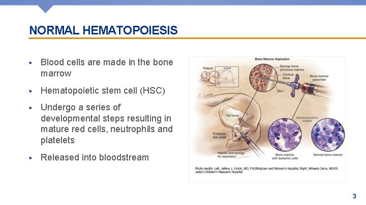 NORMAL HEMATOPOIESIS ▶ Blood cells are made in the bone marrow ▶ Hematopoietic stem