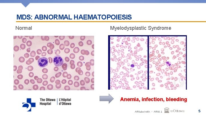 MDS: ABNORMAL HAEMATOPOIESIS Normal Myelodysplastic Syndrome Anemia, infection, bleeding Affiliated with • Affilié à