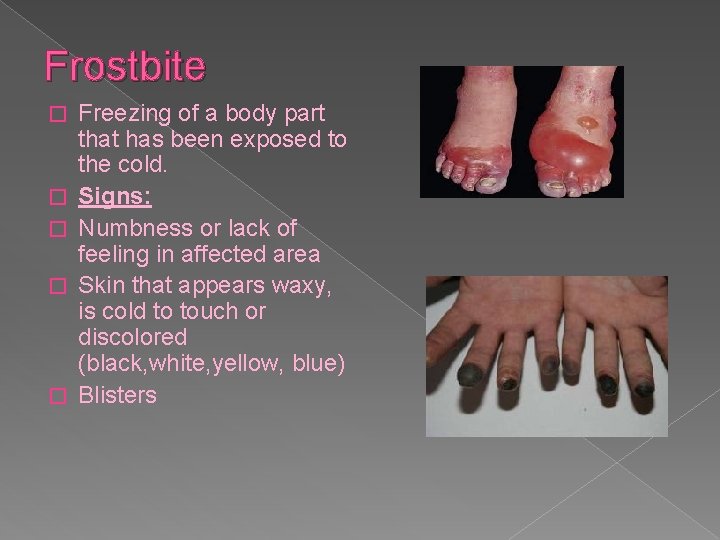 Frostbite � � � Freezing of a body part that has been exposed to