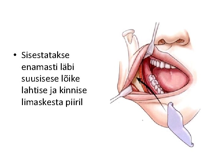  • Sisestatakse enamasti läbi suusisese lõike lahtise ja kinnise limaskesta piiril 