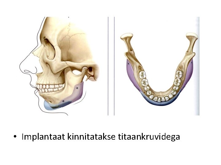  • Implantaat kinnitatakse titaankruvidega 