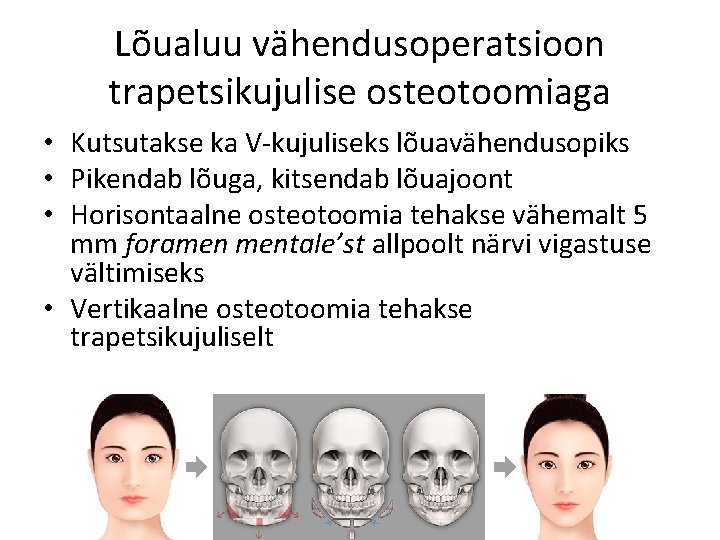 Lõualuu vähendusoperatsioon trapetsikujulise osteotoomiaga • Kutsutakse ka V-kujuliseks lõuavähendusopiks • Pikendab lõuga, kitsendab lõuajoont