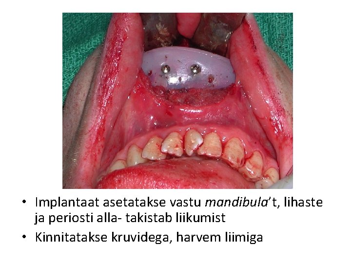  • Implantaat asetatakse vastu mandibula’t, lihaste ja periosti alla- takistab liikumist • Kinnitatakse