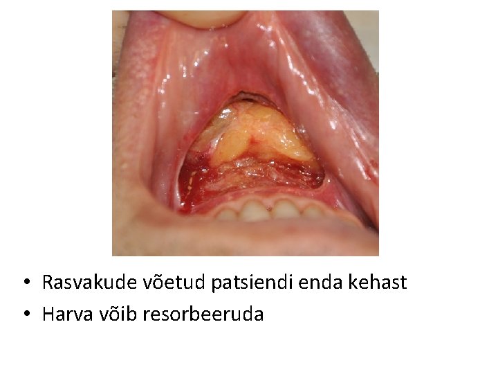  • Rasvakude võetud patsiendi enda kehast • Harva võib resorbeeruda 