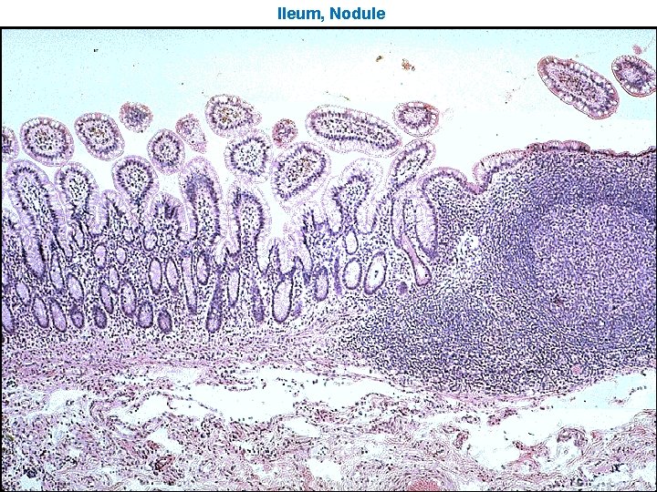 Ileum, Nodule 