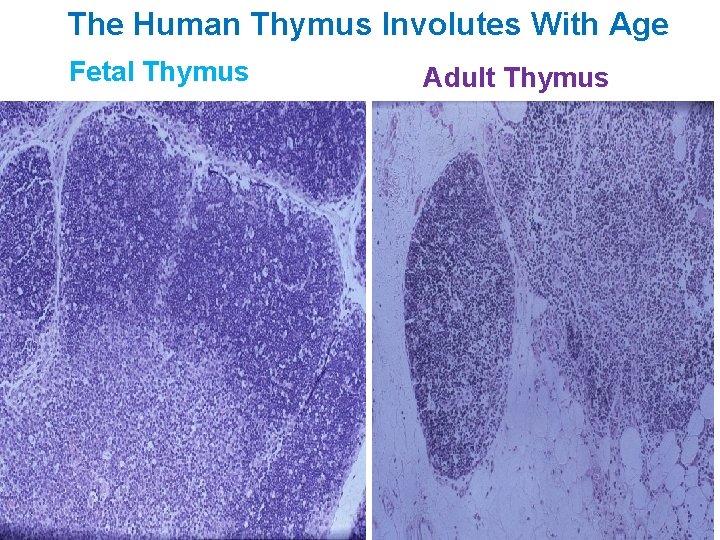 The Human Thymus Involutes With Age Fetal Thymus Adult Thymus 